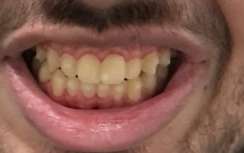 Depois do tratamento Invisalign — sorriso alinhado após acompanhamento da Dra. Carmen Calixto.