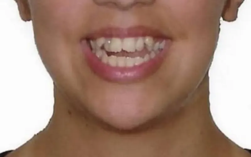 Antes do tratamento Invisalign — paciente com mordida desalinhada e canino fora de posição.