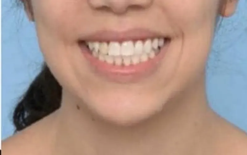 Depois do tratamento Invisalign — arcada alinhada e sorriso amplo após acompanhamento da Dra. Carmen Calixto.