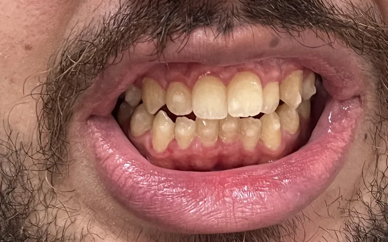 Antes do tratamento Invisalign — paciente com dentes desalinhados.